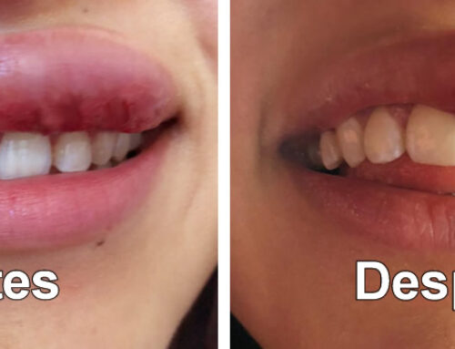 Fractura dental, diente fracturado o diente roto.